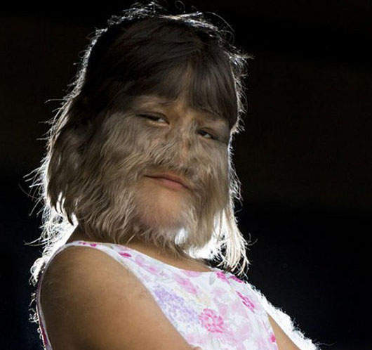 《泰國狼女》全世界毛髮最多的女孩:蘇帕特拉 《泰國狼女》全世界毛髮最多的女孩:蘇帕特拉