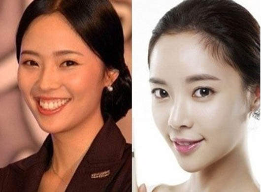 韓星  矯正牙 Before After  韓星  矯正牙 Before After