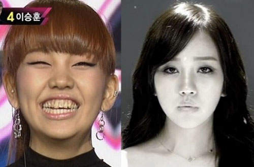 門牙真的很重要~矯正前矯正後原來差這麼多@_@