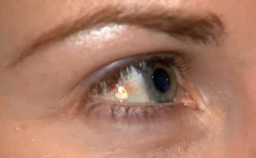 歐美另類《電眼手術》這樣真的有比較美麗嗎ಠ_ಠ？