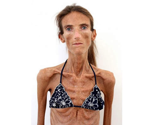 《皮包骨激瘦女》只有 25 公斤的人生⊙﹏⊙