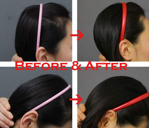 韓國《後腦勺整形手術》現在還有什麼地方不能整呢......