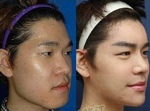 《國字男變V臉男》的整型史 但是削骨看起來超痛......>"< 《國字男變V臉男》的整型史 但是削骨看起來超痛......>"<