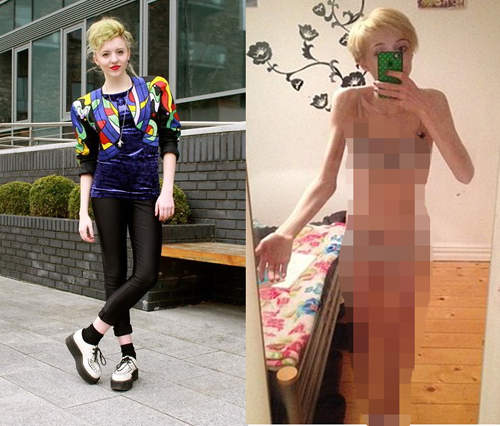 17歲《厭食症少女》得病全因網友一句話....... 17歲《厭食症少女》得病全因網友一句話.......