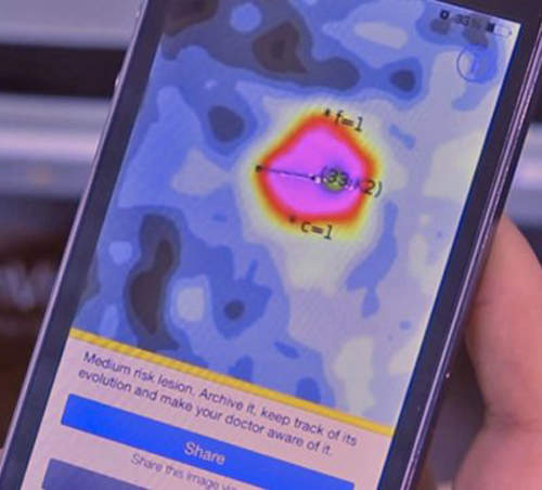 《可偵測皮膚癌的APP》早點發現就能早點治療 《可偵測皮膚癌的APP》早點發現就能早點治療