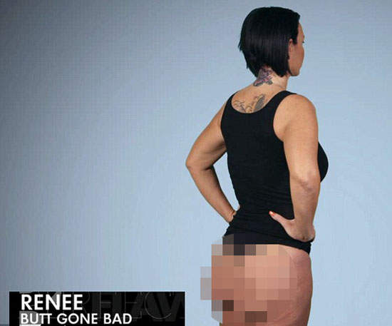 《整形失敗案例》扁扁的屁股可以自己揉到圓... 《整形失敗案例》扁扁的屁股可以自己揉到圓...