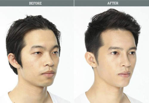 《整形before&after》趴兔 回到家媽媽都認不出來了吧...... 《整形before&after》趴兔 回到家媽媽都認不出來了吧......