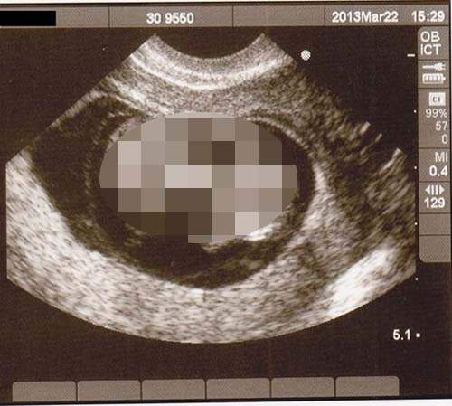 好可怕系列《寶寶的超音波照片》被照成這樣媽媽們有傻眼嗎 好可怕系列《寶寶的超音波照片》被照成這樣媽媽們有傻眼嗎