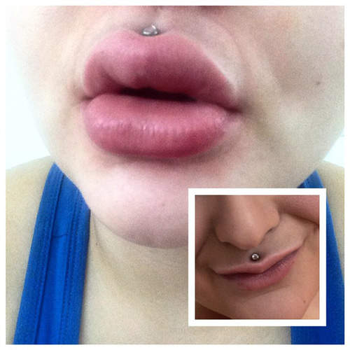 網路新風潮《免整形豐唇術》大家都這麼想變迷唇姐嗎？