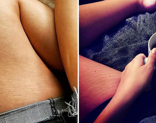 《妊娠紋自信照》沒有無瑕的肌膚但是我勇敢秀出來