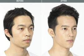 《整形before&after》趴兔 回到家媽媽都認不出來了吧...... 《整形before&after》趴兔 回到家媽媽都認不出來了吧......