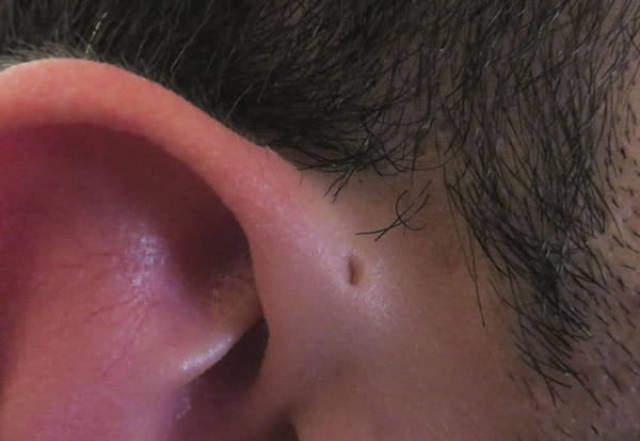 新理論《耳朵上有小洞》因為祖先原來是魚？