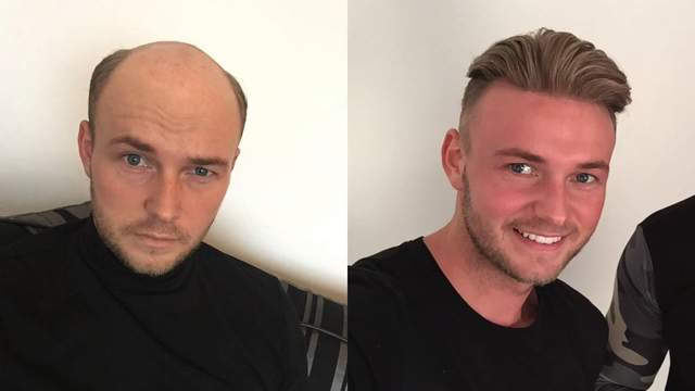 《極逼真禿頭用假髮》自從頭上有了毛～帥氣度+999呢