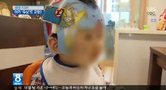 韓國媽媽《從嬰兒時期就開始追求美麗》每天都要戴23小時以上的頭盔生活......