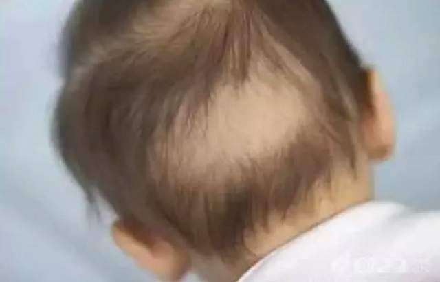 生活好難《兩歲半孩子因為壓力太大而落髮》網友狂噴媽媽的想法會不會太誇張