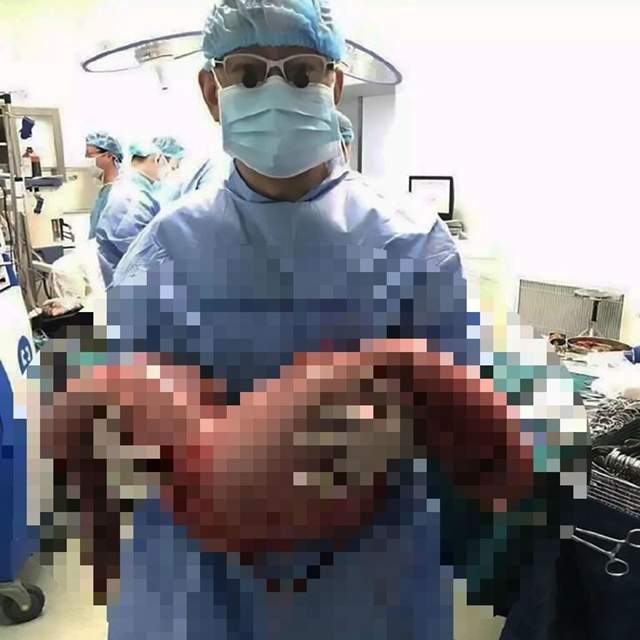 《因為便秘肚子裡出現巨型腸子》重達12公斤的腸子就這樣從體內取出......