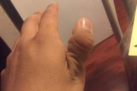 超痛社群流行《拇指脫臼照》盲目跟流行的下場就是痛翻天阿...... 超痛社群流行《拇指脫臼照》盲目跟流行的下場就是痛翻天阿......