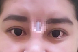 【閱覽注意】《泰女隆鼻後矽膠竟從眉心跑出》直接穿出皮膚看起來好痛阿...... 【閱覽注意】《泰女隆鼻後矽膠竟從眉心跑出》直接穿出皮膚看起來好痛阿......