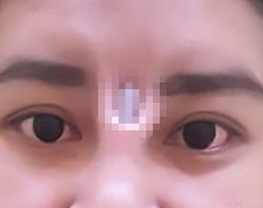 【閱覽注意】《泰女隆鼻後矽膠竟從眉心跑出》直接穿出皮膚看起來好痛阿...... 【閱覽注意】《泰女隆鼻後矽膠竟從眉心跑出》直接穿出皮膚看起來好痛阿......