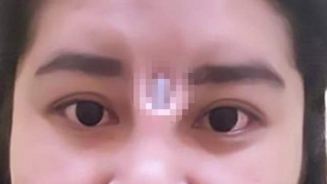 【閱覽注意】《泰女隆鼻後矽膠竟從眉心跑出》直接穿出皮膚看起來好痛阿...... 【閱覽注意】《泰女隆鼻後矽膠竟從眉心跑出》直接穿出皮膚看起來好痛阿......