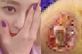 【閱覽注意】女星醫療事故留下《驚悚傷痕》像醫院反應不被理會只好怒公開... 【閱覽注意】女星醫療事故留下《驚悚傷痕》像醫院反應不被理會只好怒公開...