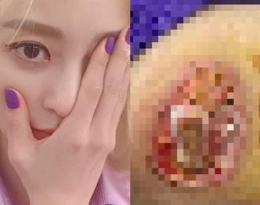 【閱覽注意】女星醫療事故留下《驚悚傷痕》像醫院反應不被理會只好怒公開... 【閱覽注意】女星醫療事故留下《驚悚傷痕》像醫院反應不被理會只好怒公開...