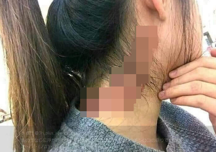 《屌打的痕跡》會不會從小時候就開始擔心這個胎記會變大呢？