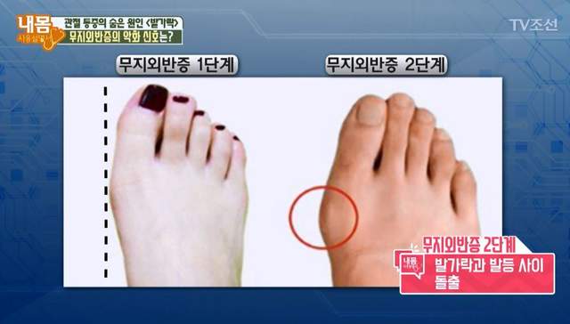 你也有這個困擾嗎《姆指外翻》醫生建議以後少穿這種鞋