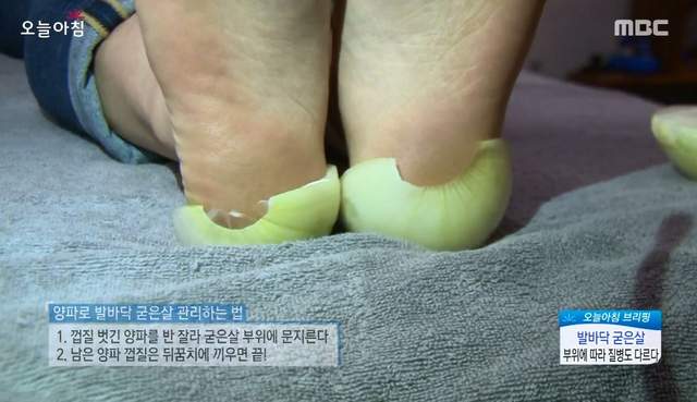 韓國節目推薦用《洋蔥》來去超硬腳皮  超可愛畫面就此出現w