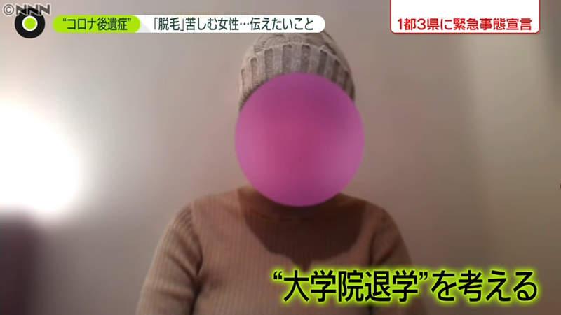 《受新冠肺炎後遺症所苦的人》研究生頭髮狂掉不敢出門見人 害怕畢業之後連工作都找不到 《受新冠肺炎後遺症所苦的人》研究生頭髮狂掉不敢出門見人 害怕畢業之後連工作都找不到